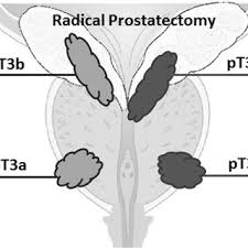 Deze ontlasting wordt gecontroleerd op bloedsporen. Marcel Janssen Nuclear Medicine Physician Md Phd Radboud University Medical Centre Radboudumc Nijmegen Nuclear Medicine