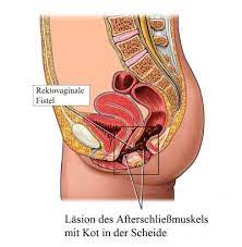 Hysterektomie Operation Gebarmutterentfernung Abdominal Folgen Dauer