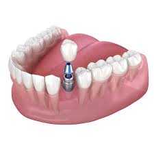 Eat what you want with dental implants by clearchoice. Dental Implants Logan Ut Garland Ut Implant Dentistry Gregory E Anderson Pc