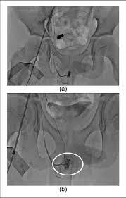 Let's talk about the amazing perks of gray blending. Figure 2 From High Flow Priapism Treated With Superselective Transcatheter Embolization Using Polyvinyl Alcohol Particles Semantic Scholar