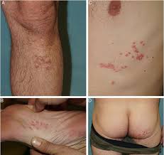 Image result for herpes zoster