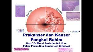 Hastalığın en sık insidansı orta ve güney amerika. Prakanser Dan Kanser Pangkal Rahim Bagaimana Ianya Boleh Berlaku Youtube