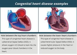 Congenital Heart Disease Healthdirect