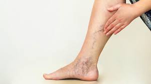 Ulcers Swelling And Cramping Spotting The Warning Signs Of Vein Disease Clement Banda Md Dermatologist