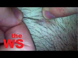 Ingrown hair is formed if, during hair removal, the hair is not completely removed; Very Old Ingrown Hair Removal Youtube