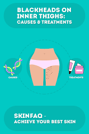 Blackheads On Inner Thighs Causes And Treatments Skincare Hero Blackheads Skin Care Treatments Inner Thigh Pimples