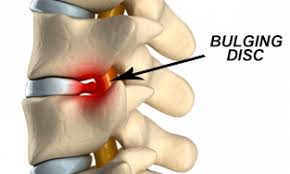 Can you sleep with a lumbar herniated disc? Types And Causes Of Circumferential Disc Bulge