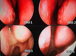 Asa ca mai stau 2 saptamani in tensiune, ca doar ma pregateam de operatie. Clinica Nova ObstrucÅ£ia NazalÄƒ Nasul Infundat