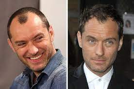 42 Celebrity Men Who Are Less Bald Than They Used To Be Hair Loss Men Balding Mens Hairstyles Bald Hair