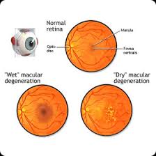 Praticienne sérieuse qui propose un traitement unique en france mais qui a fait ses preuves en suiss.e ou. Brussels Retina Specialists Association Pathologies Degenerescence Maculaire Liee A L Age