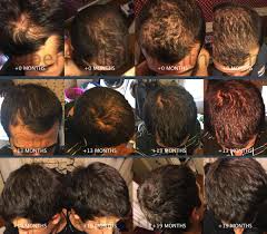 A case of reversible generalized hyperpigmentation of the skin and nails with reversible premature gray hair due to vitamin b12 deficiency is reported. Diffuse Thinning Causes Implications Steps For Regrowth Photos