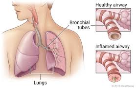 Image result for Acute Bronchitis