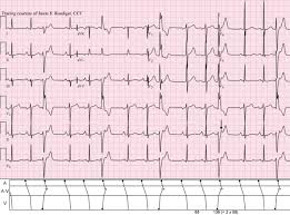 A premature ventricular contraction (pvc) is a relatively common event where the heartbeat is initiated by purkinje fibers in the ventricles rather than by the sinoatrial node. Jason S Blog Ecg Challenge Of The Week For March 10th 17th Mutual Mimics Ecg Guru Instructor Resources