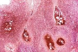 Different types of cells in the bladder can become cancerous. Bladder Cancer Practice Essentials Background Anatomy