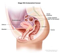This type is quite uncommon and usually begins in the muscles surrounding the womb and gradually spreading inwards to the uterus. Endometrial Cancer Hematology Oncology Associates Of Cny
