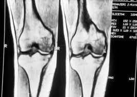 Methods sixteen knees with a small medial femoral. Radioogle Msk Medial Femoral Condyle Fracture