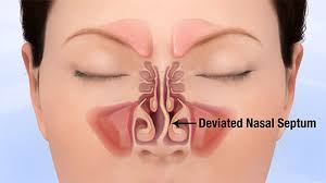 Each of these is sometimes referred to on is own as the septum, which can make references. The Problems A Deviated Nasal Septum Can Cause Bergerhenry Ent Specialty Group
