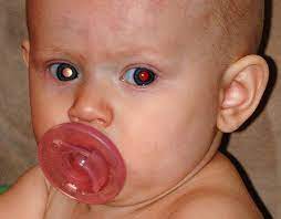If certain symptoms occur or persist, however, a doctor should be seen for further evaluation. Photored Know The Glow And Check For Normal Red Eye Reflex In Children We C Hope
