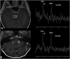 .and cerebellum, by specific magnetic resonance imaging (mri) changes, perivascular lymphocytic infiltration in the autoimmune stem encephalitis. Diffuse White Matter Alteration In Clippers Advanced Mri Findings From Two Cases Sciencedirect