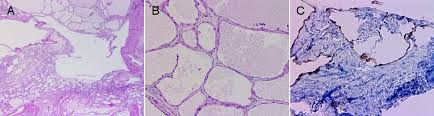 A collection of surgical pathology images. Cureus Benign Multicystic Peritoneal Mesothelioma Presenting As A Colonic Mass
