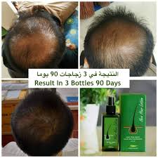 Check spelling or type a new query. Neo Hair Lotion Herbs 100 Natural Treatment Spray Stop Hair Loss Root Beard Sideburns Longer Nutrients Msds Report Support Hair Loss Products Aliexpress