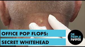 When it comes to pimple popping videos on youtube, you're either intrigued and satisfied or totally horrified. A Nice Whitehead On The Neck Office Pop Flop Youtube