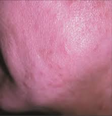 Are Seasonal Allergies The Cause Of This Pruritic Rash Consultant360