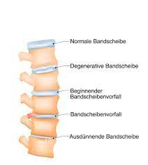 Ein bandscheibenvorfall (diskusprolaps) ist ein häufiger grund für rückenschmerzen. Bandscheibenvorfall Symptome Und Behandlung Brigitte De
