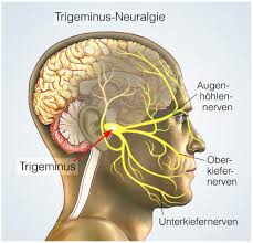 Trigeminusneuralgie Symptome Ursachen Hilfe Ratgeber Nerven