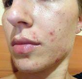 Mon Histoire Acne Arret Pilule Diane 35 Consultations Medicales Et Traitements Naturels Acne Hormonal Remede Acne Acne