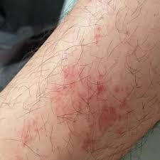 Image result for Vasculitis