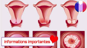 Le programme national de dépistage. Voici Les Symptomes Du Cancer Du Col De L Uterus Chaque Femme Doit Savoir Cela Pause Fun