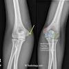 Transphyseal fractures of the distal humerus are most commonly seen in children younger than six years of age. Https Encrypted Tbn0 Gstatic Com Images Q Tbn And9gcq P0fjgnn347xait1nozcei 2cz7t Swapquhi9bv0brgfxj Usqp Cau