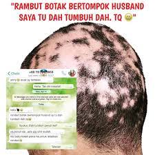 Masalah rambut gugur biasanya dilalui oleh semua golongan wanita mahupun lelaki. Pin Pa Pelebat Rambut Paling Berkesan