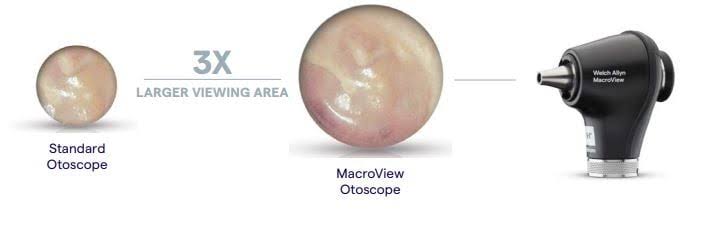 Welch Allyn MacroView Plus Otoscope 廣角視野示意