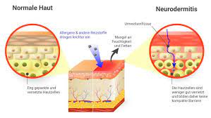 Atopisches Ekzem Neurodermitis Ursachen Im Uberblick Haut Ratgeber De Neurodermitis