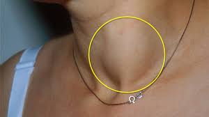 You have the good thyroid cancer. Thyroid Cancer Basics And What We Need To Know Lifestyle General Kerala Kaumudi Online