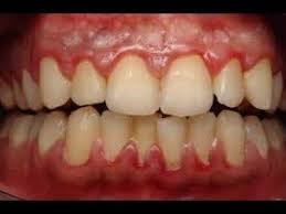 Ibrahim Saracoglu Dis Eti Iltihabi Dis Eti Cekilmesine Ne Iyi Gelir Gum Disease Remedies Gum Treatment Gum Disease Treatment