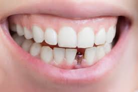 For that, patients have to participate in various programs organized by the schools and institutions. Everything You Need To Know About Dental Implants Jiva Dental