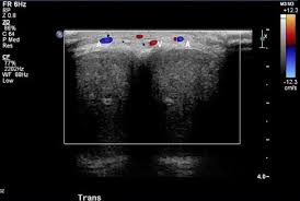 Image result for Priapism