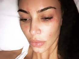 Kim kardashian zeigt sich ungeschminkt! Schuppenflechte Im Gesicht Kim Kardashian Zeigt Sich Ungeschminkt N Tv De