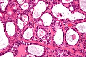 Symptoms become more noticeable as the cancer progresses. Clear Cell Ovarian Carcinoma Wikipedia