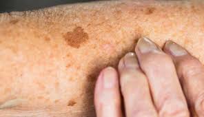 Image result for brown patches on the feet