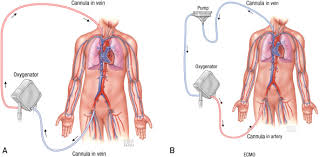 Usually at royal papworth hospital we have three respiratory ecmo patients at any one time, with approximately 15 across the five centres. Decisions To Withdraw Extracorporeal Membrane Oxygenation Support Patient Characteristics And Ethical Considerations Mayo Clinic Proceedings