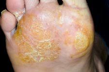 Image result for pompholyx soles of feet