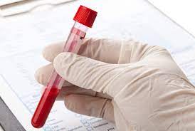 The syphilis test is performed as a blood test. Std Blood Test Results Explained Std Testing Hiv Testing Same Day Std Testing