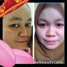 Selain parut luka, anda juga boleh menggunakannya untuk memudarkan parut jerawat pada muka. Krim Hilangkan Parut Jerawat Dan Jeragat Posts Facebook