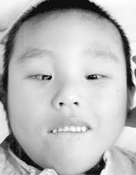 A First Reported Case of Oculocerebrorenal Syndrome of Lowe in Hong Kong  and Review of Literature