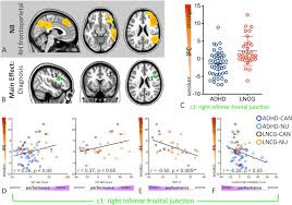 People with dyslexia have normal intelligence and usually have normal vision. Distinct Effects Of Childhood Adhd And Cannabis Use On Brain Functional Architecture In Young Adults Sciencedirect
