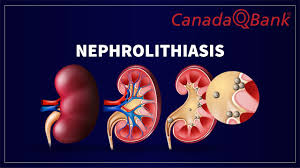 Image result for Nephrolithiasis